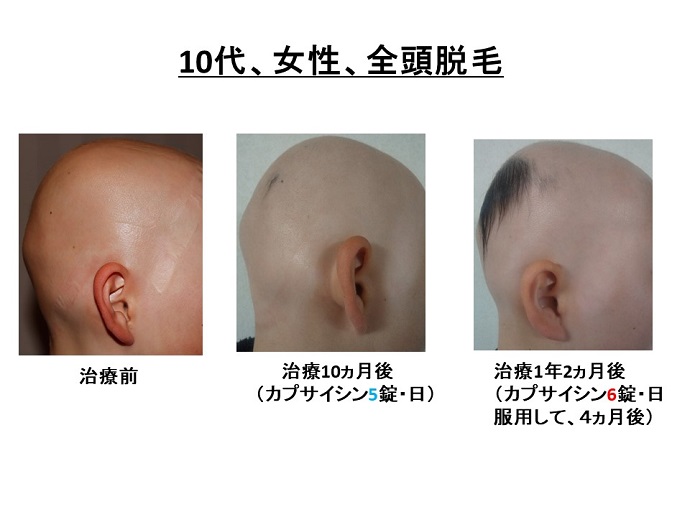 円形脱毛症　病院